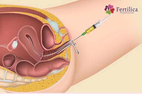 IUI Treatment